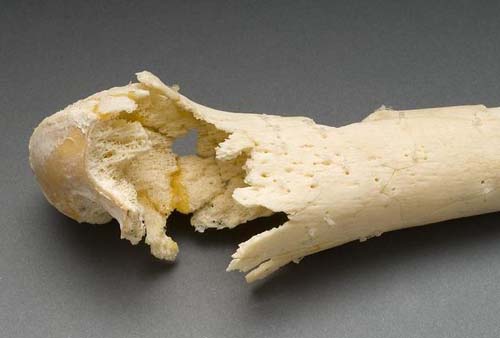 bone shattered by gunshot wound